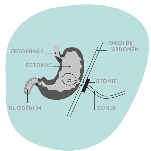 Sondes et boutons de gastrostomie ou jéjunostomie